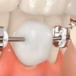COMO USAR A CERA ORTODÔNTICA PARA PROTEÇÃO?