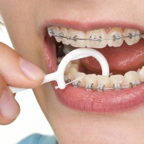 DICAS PARA INCENTIVAR O USO DO FIO DENTAL COM APARELHO ORTODÔNTICO