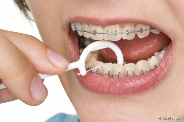 DICAS PARA INCENTIVAR O USO DO FIO DENTAL COM APARELHO ORTODÔNTICO Dra Bianca Paludo DICAS PARA INCENTIVAR O USO DO FIO DENTAL COM APARELHO ORTODÔNTICO Dra Bianca Paludo